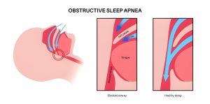 Snoring treatment in Dwarka